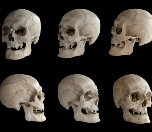 What Are the Different Skull Landmarks?